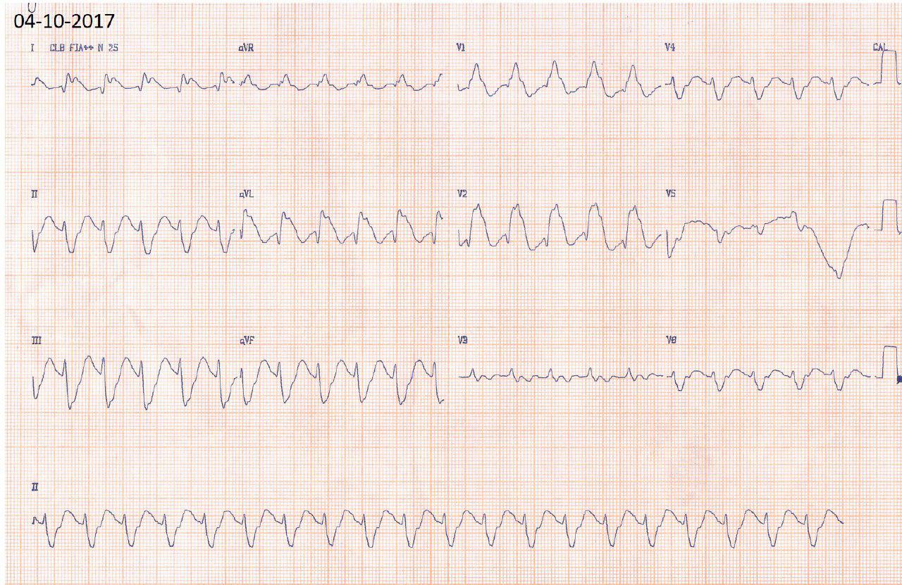 Mujer de 51 años HTA y TBQ con IAM anterior por trombo en TCI y lesión severa de DA