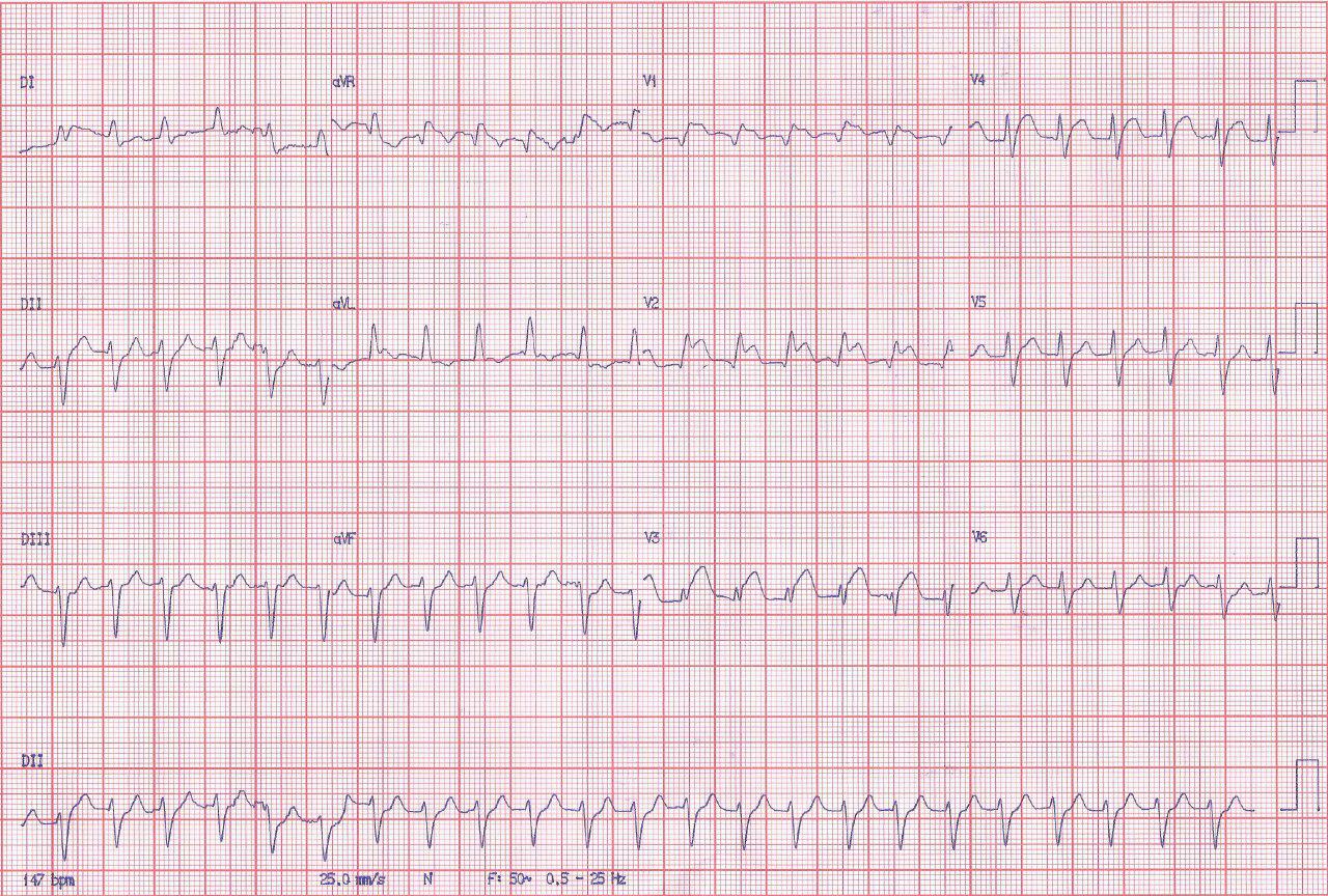 Paciente de 71 años con angor prolongado por obstrucción proximal de DA con trombo y fracaso de la angioplastia