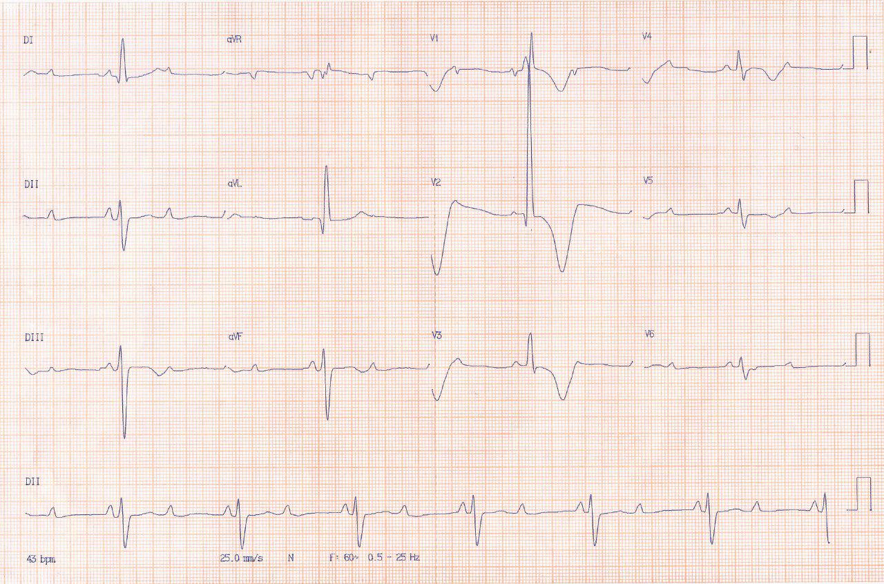 Paciente de 86 años con síncopes a repetición por bloqueo tetrafascicular