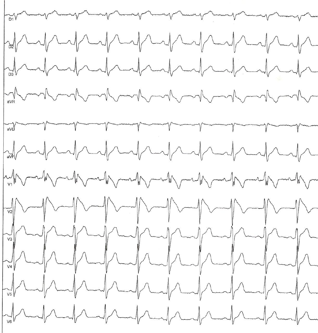 Hombre joven sin antecedentes familiares con Síndrome de Brugada tipo 1