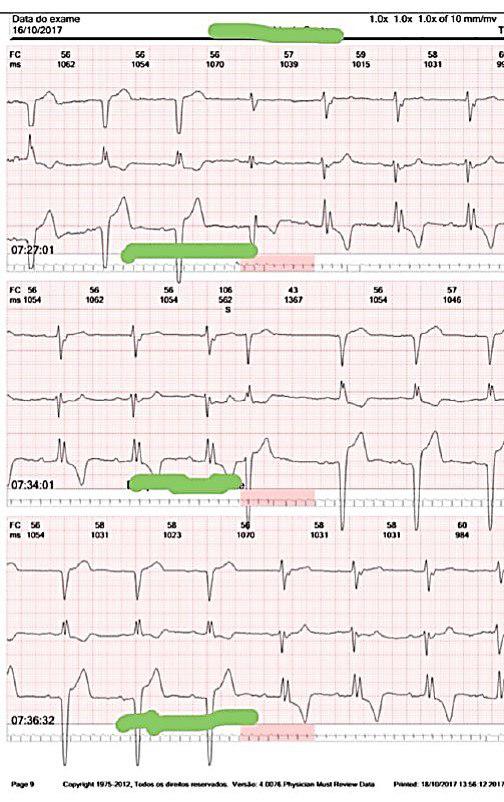 Hombre de 90 años con historia de síncopes por bloqueo de rama bilateral