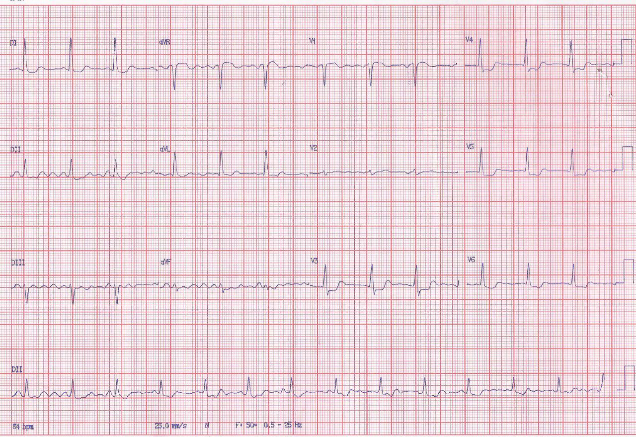 Femenina de 63 años con FR, que presenta angor ante emociones por presencia de un puente muscular intramiocárdico