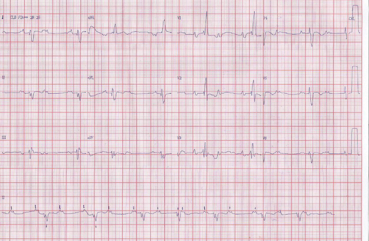 Hombre de 68 años con dolor precordial de esfuerzo, síncope, bloqueo tetrafascicular y coronarias normales en CCG