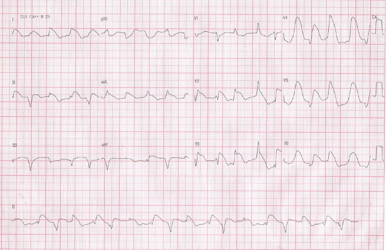 Mujer de 40 años con precordialgia atípica atribuible a Síndrome de TakoTsubo, fenocopia de Brugada e hipotiroidismo asociado