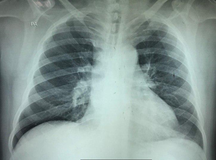 Paciente obeso con cuadro de disnea súbita por TEP con patrón S1Q3T3 en el ECG