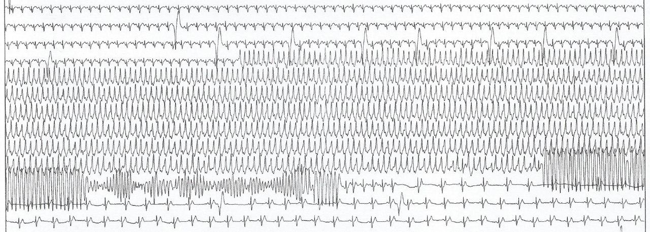 Hombre de 51 años portador de miocardiopatía arritmogénica de VI presenta TV y torsade de ponte durante PEG