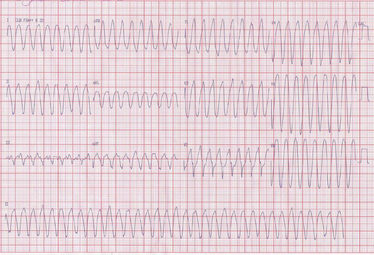 Portador de prótesis aórtica St. Jude normofuncionante con episodio de TV