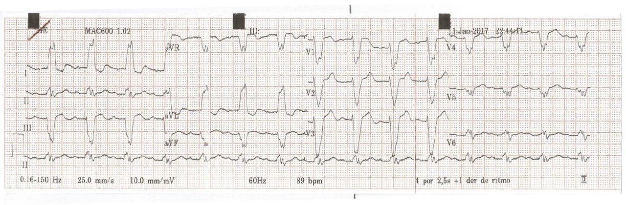 Paciente portadora de Enfermedad de Steinert que presenta trastornos de la conducción intraventricular que simulan BCRI