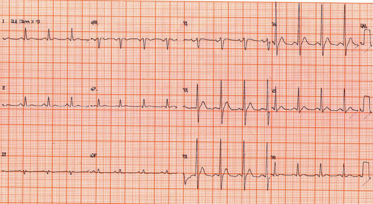 Paciente de 77 años con hipernefroma y CA de próstata que cursa con hipercalcemia