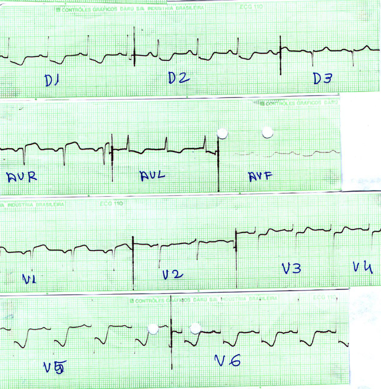 Mujer hipertensa de 56 años que presenta disección aórtica tipo A con EAP
