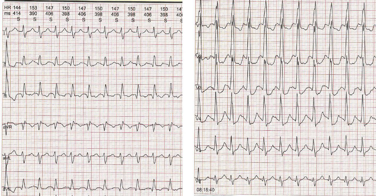 Mujer de 86 años con enfermedad de Alzheimer e hipotiroidismo que presenta Taquicardia auricular por sobredosis de hormonas tiroideas