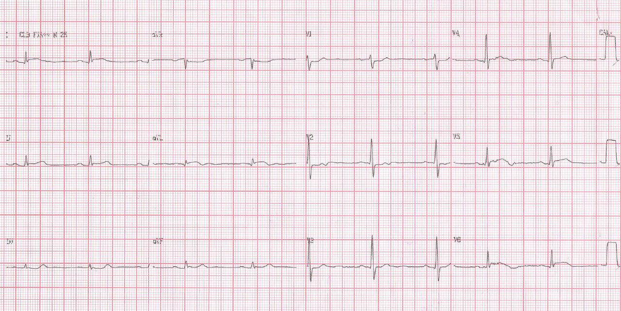 Paciente de 51 años con cuadro de SCACEST por obstrucción de la arteria marginal de la Cx