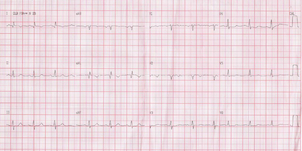 Mujer de 55 años con antecedente  de implante de stent en TCI y DA con desarrollo de circulación colateral. Reoclusión del TCI