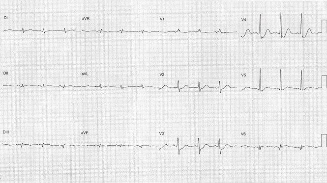 Paciente de 62 años con infarto ínfero basal por lesión de Cx con fracaso de reperfusión, isquemia de músculo papilar e IM severa y TV fascicular