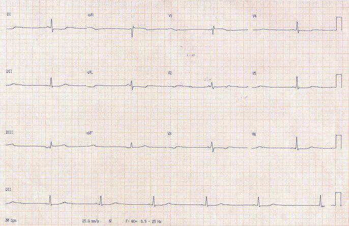 Mujer de 43 años operada de sarcoma de AI. Consulta por disnea y episodio sincopal