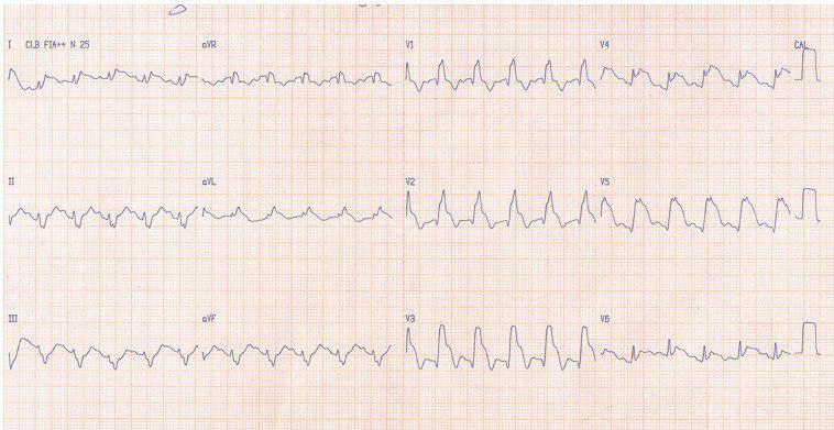 Hombre de 54 años con SCA por oclusión de la DA proximal