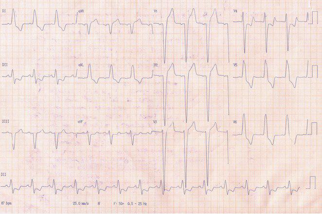 Paciente de 69 años con EAP que presenta lesión de DA y primera Diagonal con BCRI en el ECG