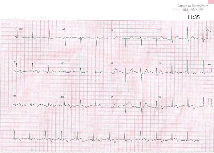 ECGs evolutivos de hombre de 71 años con angor prolongado por oclusión de CD proximal