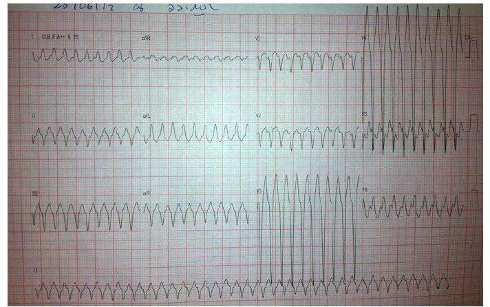 Paciente de 50 años portador de vía anómala y usuario de crack