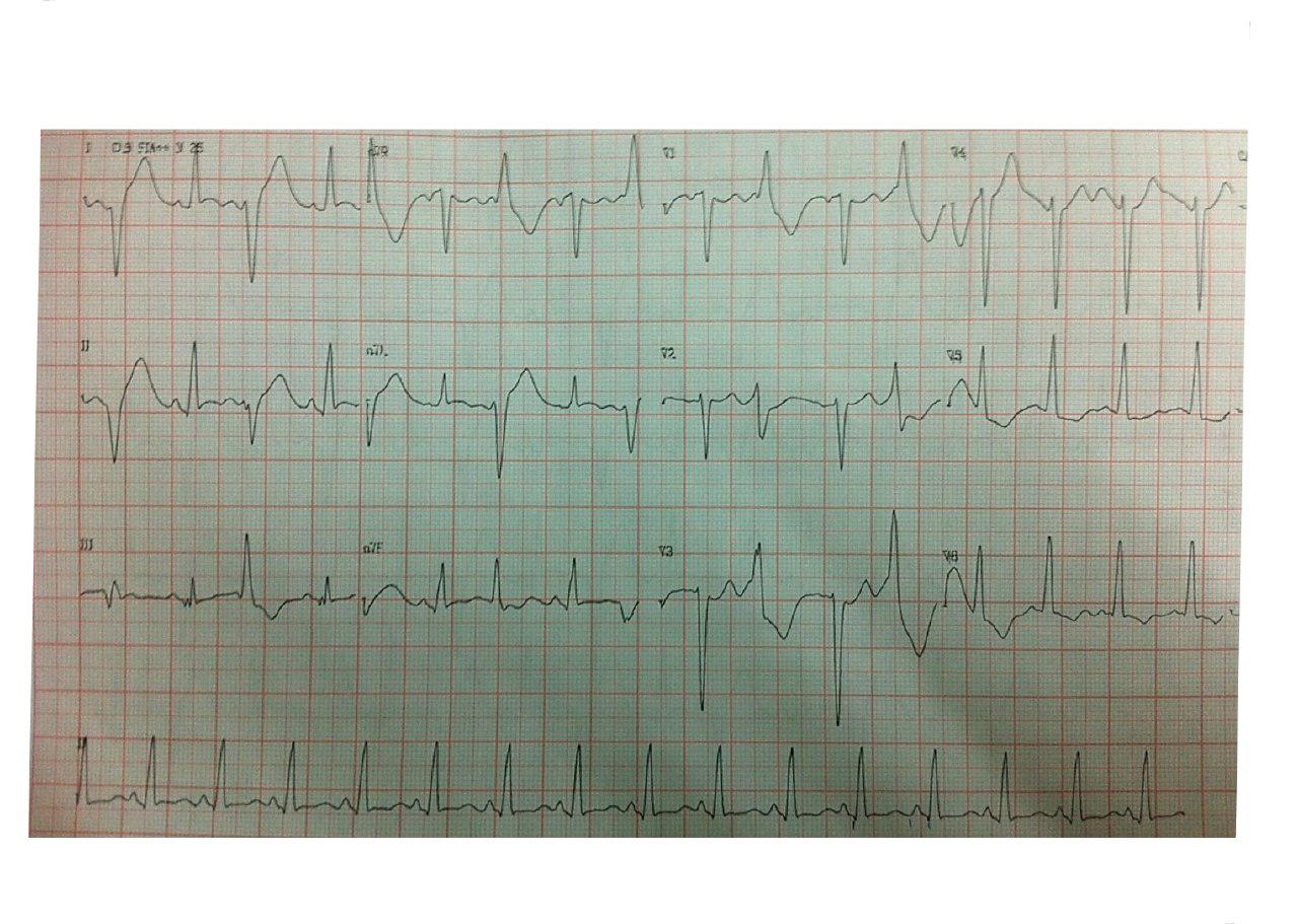 Paciente hipotiroideo que abandonó el tratamiento y presenta TV polimorfa/FV con CVE exitosa