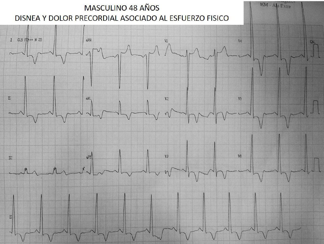 Paciente de 48 años portador de miocardiopatía hipertrófica apical con angor y disnea de esfuerzo