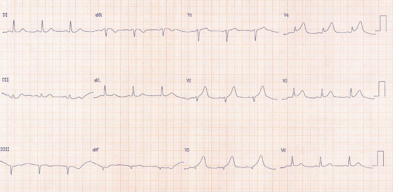 Paciente con episodio de angor prolongado y signos de isquemia aguda en el primer ECG