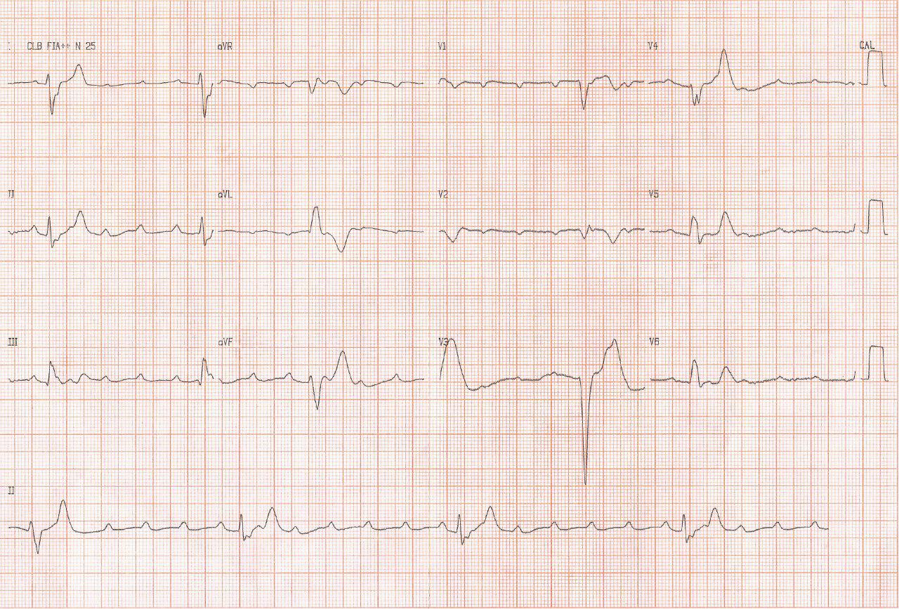 Hombre de 51 años con episodio sincopal