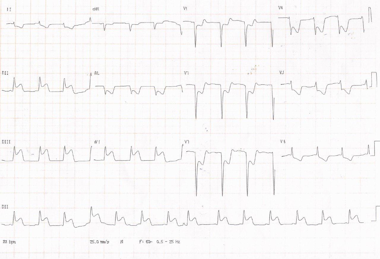 Paciente de 60 años con SCA por enfermedad de múltiples vasos