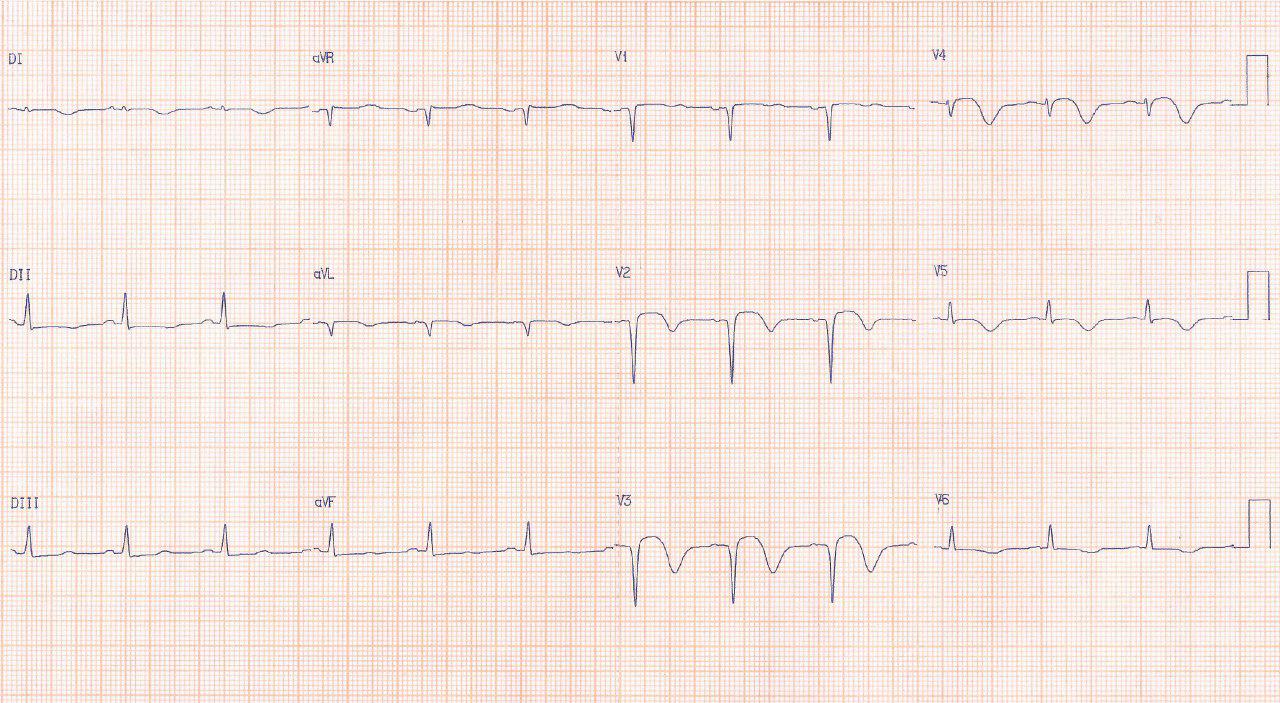 Paciente de 61 años que ingresa con cuadro de FV y hace 1 semana recibió implante de stent en DA