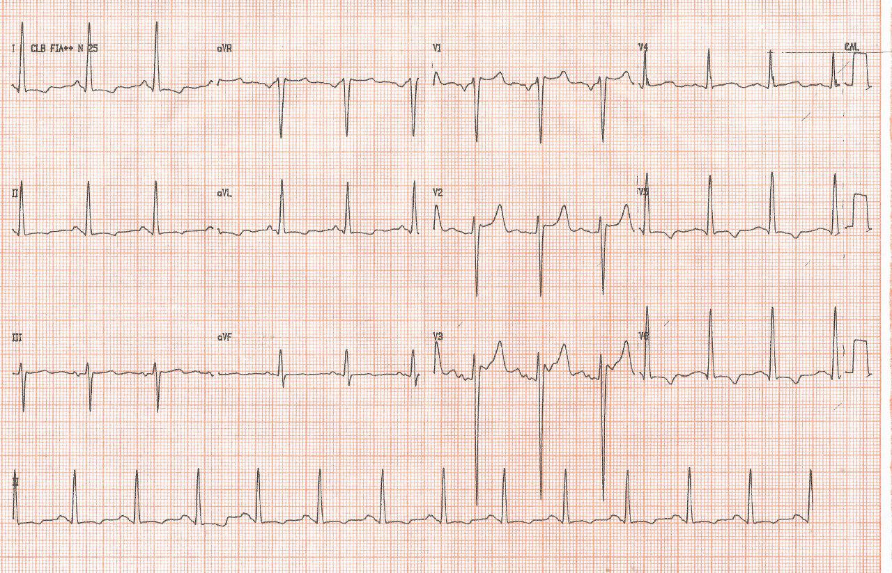 Mujer de 53 años hipertensa, con soplo sistólico aórtico por coartación aórtica