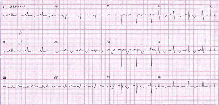 Paciente coronario crónico que presenta pseudonormalización de la onda T intradolor tratado con angioplastia