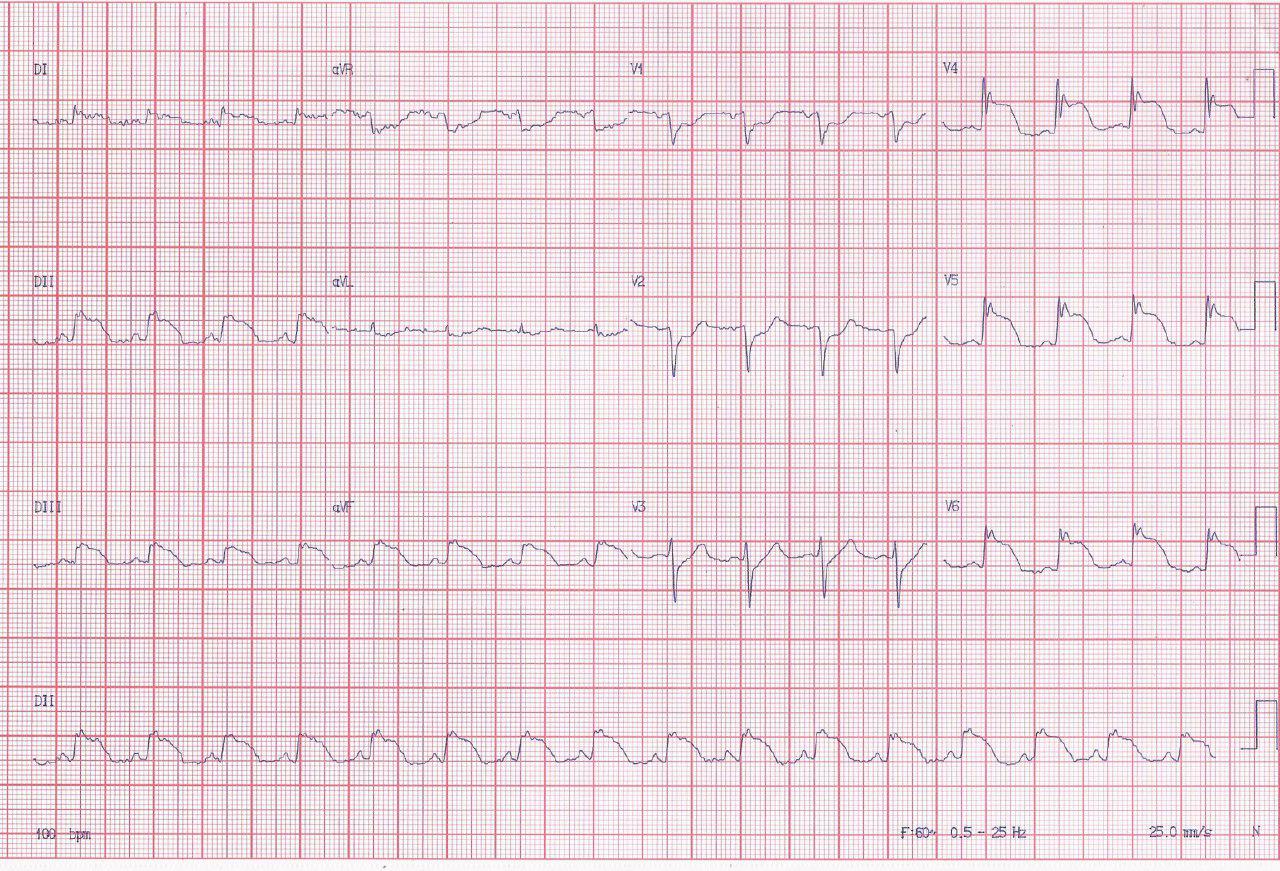 Paciente de 54 años con miopericarditis séptica por foco en brazo derecho