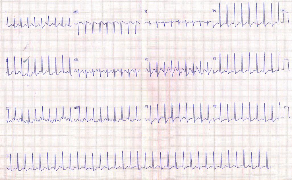 Paciente de 25 años con TPSV ortodrómica con respuesta incaracterística a adenosina y desarrollo de FA antidrómica