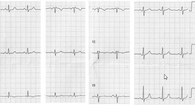ECG de rutina en mujer joven con patrón rsr’ en V1 por pectum excavatum