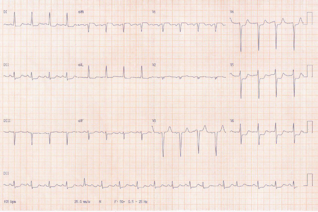 Paciente de 71 años con IRC presenta angor y disnea con evolución a EAP y fallecimiento