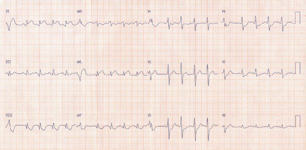 Paciente de 52 años con revascularización hace tres semanas, presenta angor prolongado e inestabilidad hemodinámica