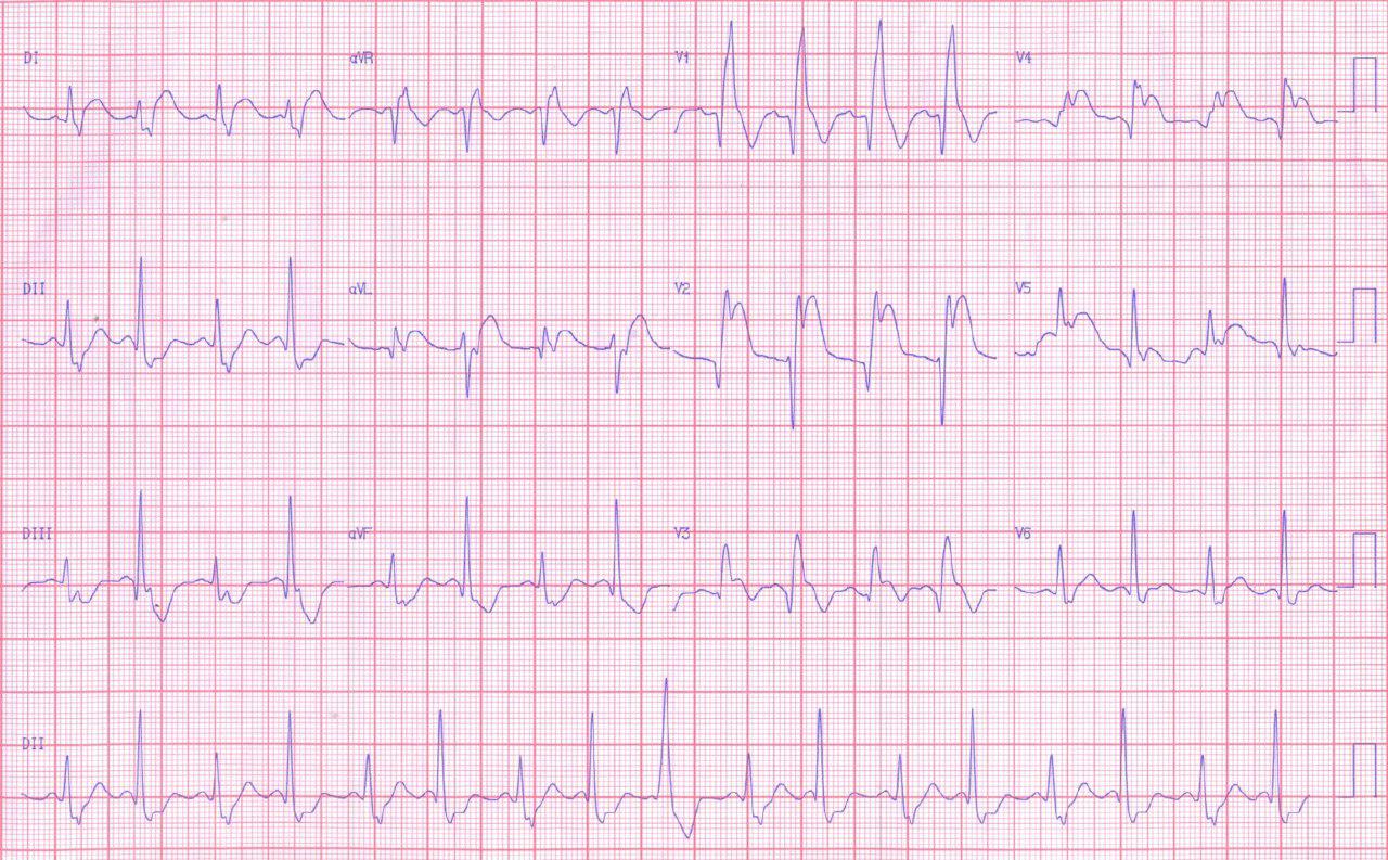 Síndrome coronario agudo por oclusión proximal de DA con severo trastorno de conducción bilateral con fracaso de la angioplastia aunque mejora de la conducción