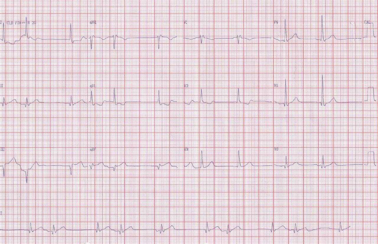 Hombre de 66 años con angor prolongado por compromiso de CD con infarto de aurícula y ritmo escape captura