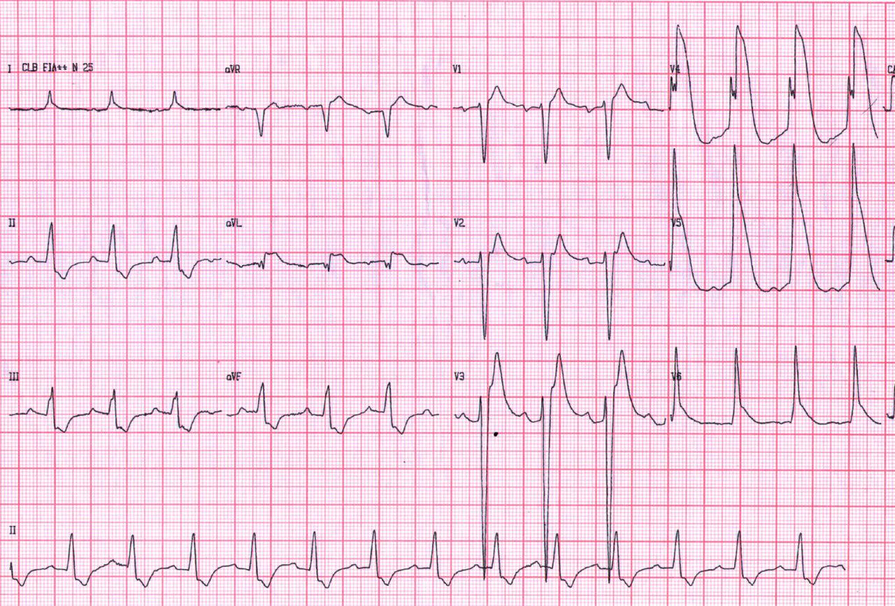 Masculino de 56 años portador de miocardiopatía dilatada no isquémica con antecedentes de síncope por FV que revierte con CVE