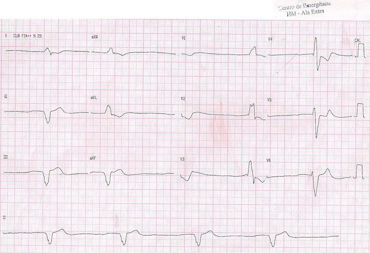 Masculino de 71 años con insuficiencia cardíaca por miocardiopatía dilatada chagásica y signos de intoxicación digitálica