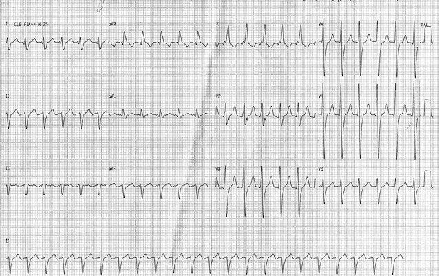 Paciente de 61 años portador de prótesis mitral y aórtica con BCRD previo que presenta aleteo auricular 1:1 y con bloqueo variable post adenosina
