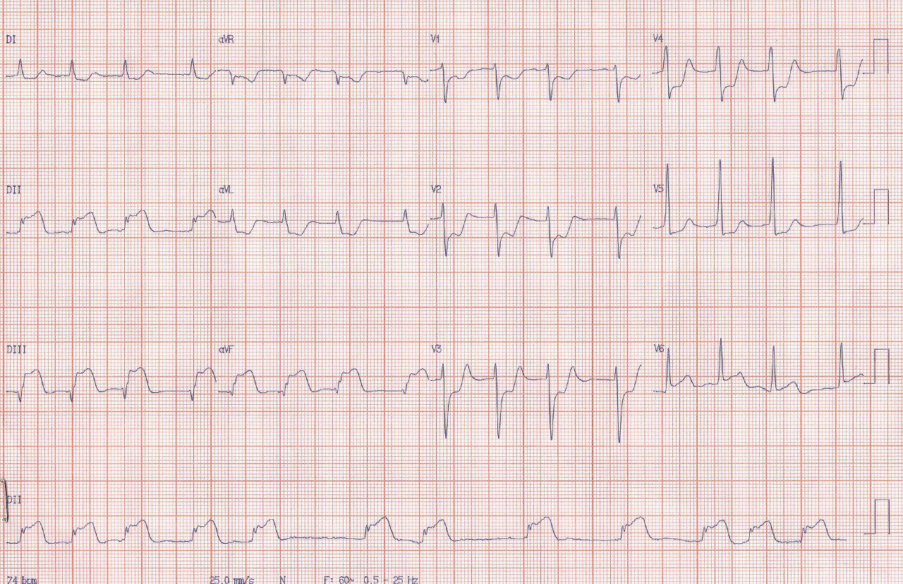 Paciente de 82 años con SCA por lesión y trombo de CD proximal que migra a distal