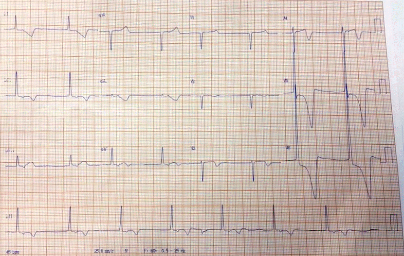 Hombre hipertenso con súbita disminución del estado de conciencia por isquemia masiva cerebral