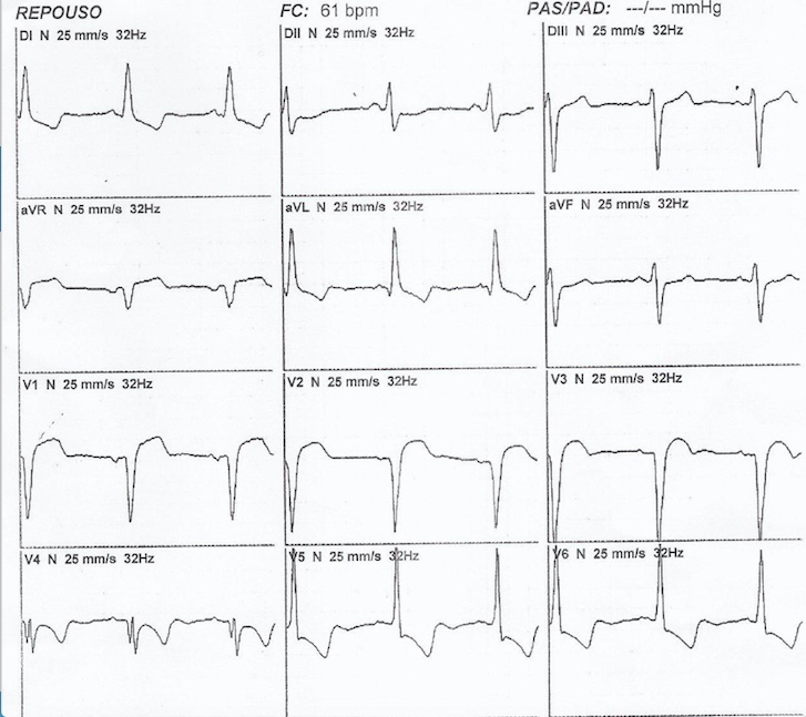 Hombre de 80 años con angor prolongado por oclusión con trombo de ADA