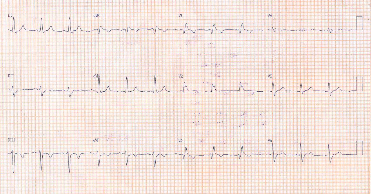 Paciente de 90 años con síncope y precordialgia atípica. Doble lesíón aórtica leve. Presenta TV y arterias coronarias normales