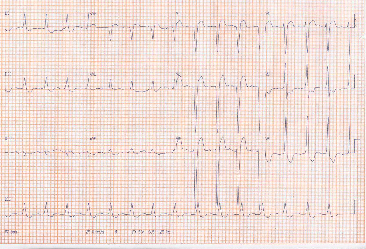 Paciente de 83 años, en uso de digital que presenta cambios en ECG atribuibles a ella