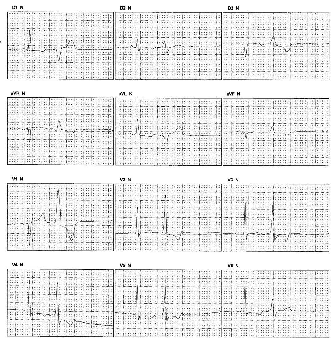 Hombre de 67 años con arritmia ventricular desde hace 20 años después de un  episodio gripal