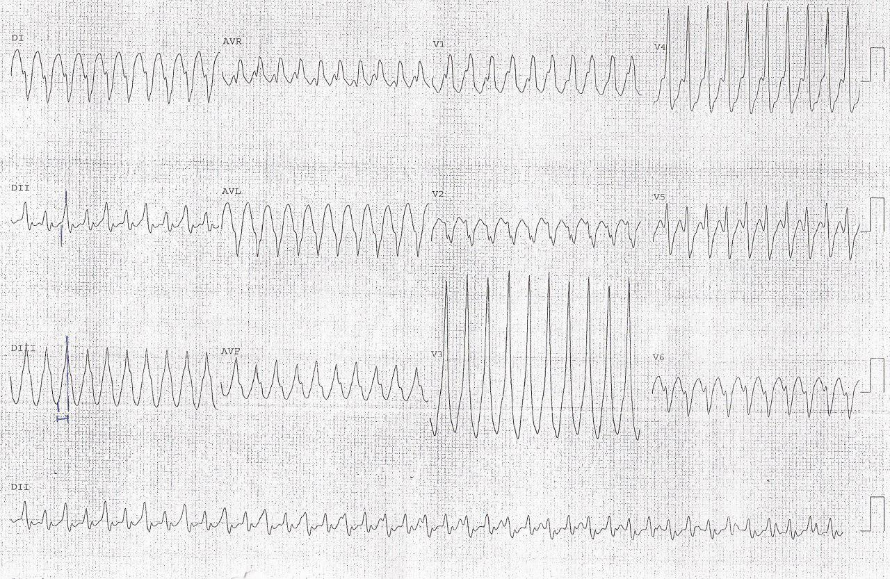 Hombre de 46 años que presenta episodios sincopales por taquicardia de QRS ancho