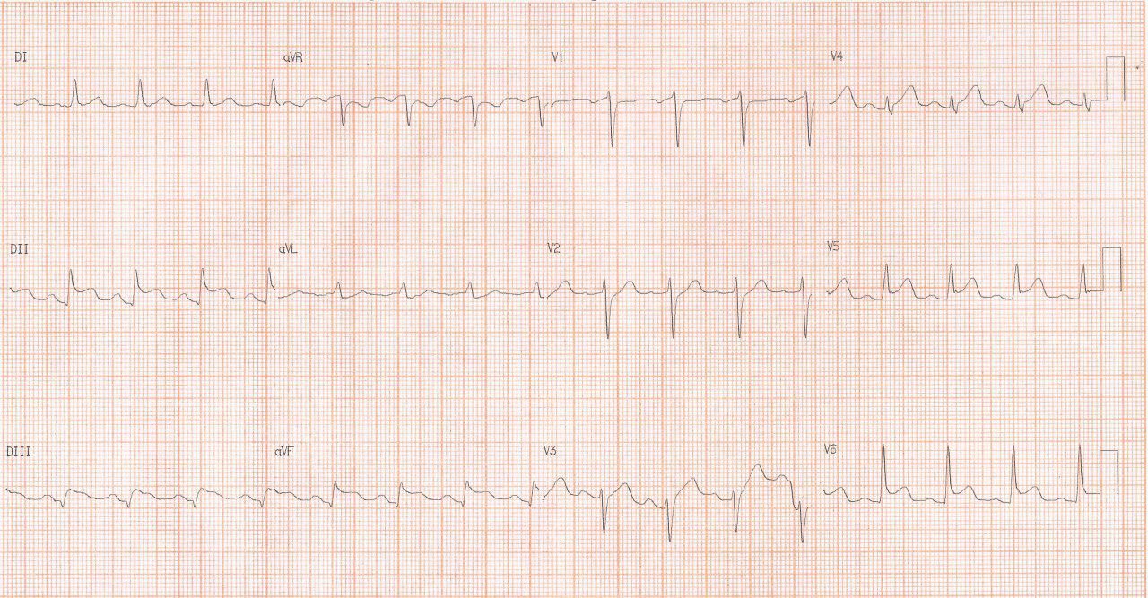 Paciente de 34 años con ardor precordial, pequeño derrame pericárdico en el eco y CCG normal por pericarditis aguda