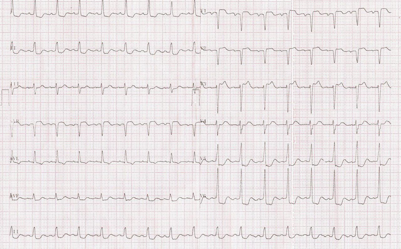 Paciente de 87 años con angor prolongado por enfermedad coronaria multivasos
